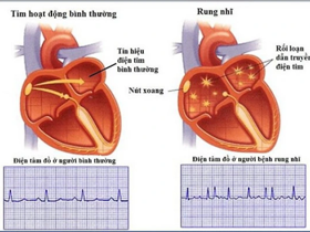 Cẩn trọng rung nhĩ - nguy cơ gây đột quỵ não